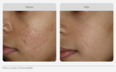 Micro Needling Results Before and After